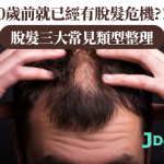 30歲前就已經有脫髮危機?!脫髮三大常見類型整理